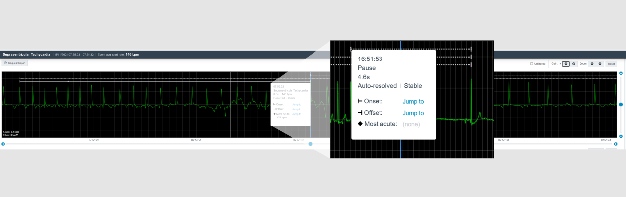 ECG Insight system showing a heart rhythm strip and the onset/offset feature.